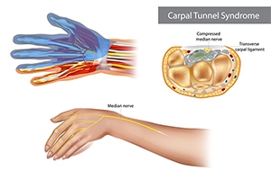 Can Carpal Tunnel Keep You Awake at Night? Causes, Symptoms, and Relief