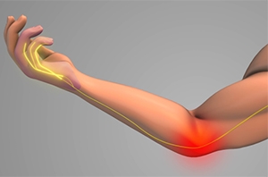 Cubital Tunnel Syndrome: A Growing Diagnosis and Why It's Often Confused with Carpal Tunne...
